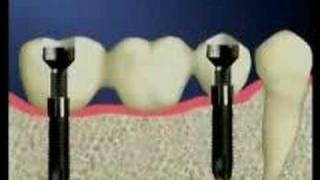 Dental Implants Bangkok Thailandwwwthaiimplantcentercom [upl. by Johnath646]