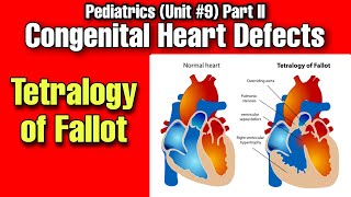 Obstructive Heart DefectsA Guide to Tetralogy of FallotStenosis and Transposition of Great Vessels [upl. by Yednil]