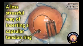 CTR insertion technique with less capsular stress in cataract surgery [upl. by Laumas829]