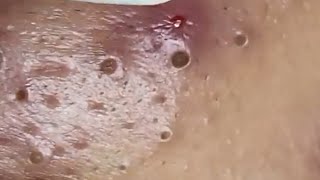 Blackheads amp Whiteheads Satisfying Removal 0104 [upl. by Erreip475]