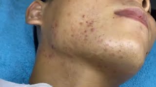 Big Cystic Acne Blackheads Extraction Blackheads amp Milia Whiteheads Removal Pimple Popping 10123 [upl. by Anniahs737]