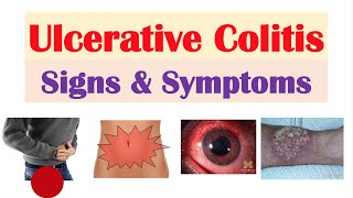 Ulcerative Colitis Signs and Symptoms amp Why They Occur and Complications [upl. by Hugibert]