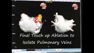 Atrial Fibrillation Ablation part 3 of 3 How to Perform Pulmonary Vein Isolation [upl. by Cynthla]