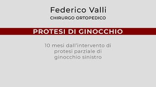 Protesi di Ginocchio 10 mesi dalloperazione di protesi parziale [upl. by Baum285]