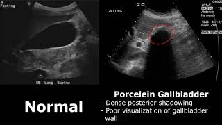 Gallbladder Ultrasound Normal Vs Abnormal Image Appearances Comparison  Gallbladder Pathologies [upl. by Eityak566]