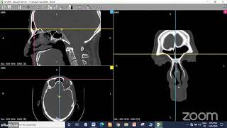 Sinonasal polyposis  Functional Endoscopic Sinus Surgery  FESS   Dr Satish Jain [upl. by Ioves582]