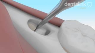 Exodoncia COMPLEJA tercer molar incluido  Video 3D paso a paso [upl. by Flanna]