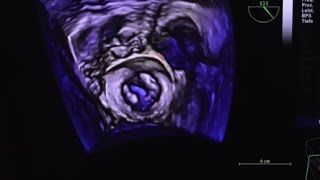 post rheumatic mitral valve stenosis [upl. by Nnylarak]