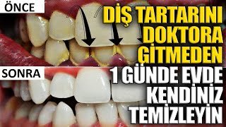 Diş Tartarını Doktora Gitmeden 1 Günde Evde Kendiniz Temizleyin [upl. by Eleazar]