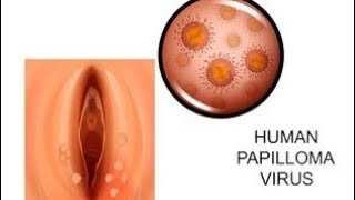 Genital warts जननांगों पर मस्से amp parmanent treatment [upl. by Urata]