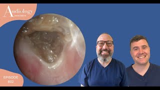 SKIN ENCASED EAR WAX PLUG REMOVAL EP802 [upl. by Robin]