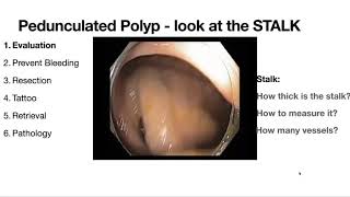 MDACC Endoscopy Refresher  Zoom Class 22  Pedunculated Polyp  Loop [upl. by Yelnet]