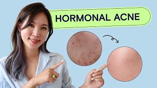 How To Treat Hormonal Acne  Acne School EP03 Health [upl. by Assenna894]