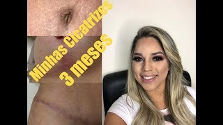 ABDOMINOPLASTIA  MAMOPLASTIA COM SILICONEquotMinhas cicatrizes e auto estima [upl. by Porche]