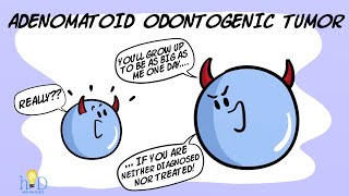 Adenomatoid odontogenic tumor [upl. by Rosen]