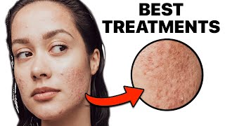 How To Get Rid of Acne Scars [upl. by Holleran675]