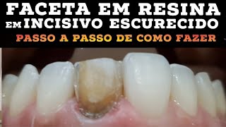 ðŸ›‘FACETA EM RESINA COMPOSTA EM INCISIVO ESCURECIDO PASSO A PASSO NA PRÃTICA  CORES PIGMENTOSðŸŽ¯ðŸ¤« [upl. by Hiller]