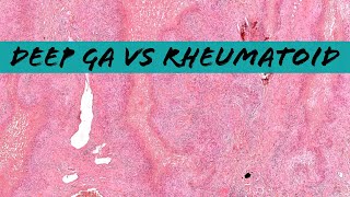 Deep Granuloma Annulare vs Rheumatoid Nodule palisaded necrobiotic granuloma pathology dermpath [upl. by Acissej]