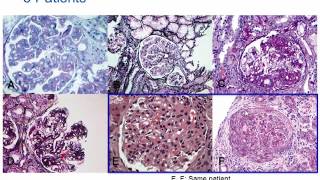 Understanding Membranoproliferative Glomerulonephritis Part 2 Hot Topic [upl. by Carbone944]