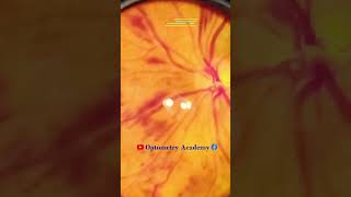 Diabetic retinopathy  Hemorrhages  proliferative diabetic retinopathy PDR  Short Video 182 [upl. by Kokaras]