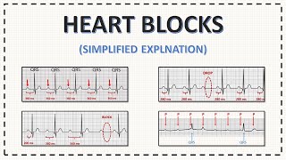 Atrioventricular Blocks AV Blocks  EKG Interpretation  LevelUpRN [upl. by Yzus]