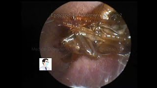 Common cerumen embolism and removal of insects in the ear11mins20230102 [upl. by Leuname]