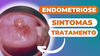 ENDOMETRIOSE sintomas e tratamento [upl. by Rycca]