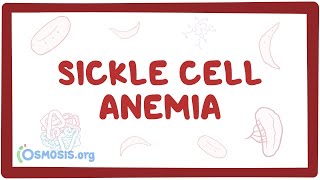 Sickle cell anemia  causes symptoms diagnosis treatment amp pathology [upl. by Ailhad278]