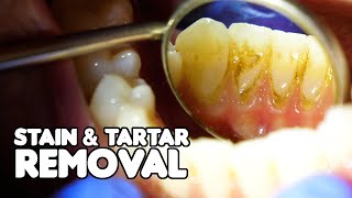 Dental Cleaning EXPLAINED  Stain amp Tartar Removal [upl. by Sorci]