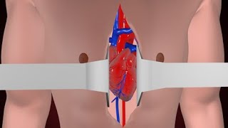 Open heart Bypass Surgery 3D Animation [upl. by Arakawa791]