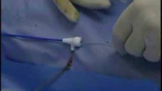 endovenous laser treatment evlt with Dr Steven E Zimmet [upl. by Laird]