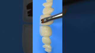 Composite veneers Dental restoration teeth compositeveneers compositerestoration dentalstudent [upl. by Teiluj]