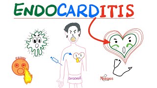 Infective Endocarditis  Fever amp New Murmur  Modified Duke’s Criteria  Cardiology Playlist [upl. by Atnim299]