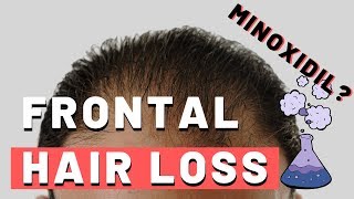 Frontal Hair Loss  Does Minoxidil Work [upl. by Guerin]