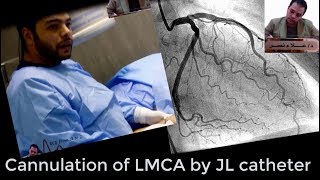 Left coronary system angiographic cannulation by JL catheterDr Alaa Nasr2019 [upl. by Sakovich296]