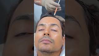 Trichometric PRP Hair Treatment to Deal With Hair Loss [upl. by Aramak728]