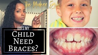 Does your child need braces Top 2 signs to look for [upl. by Quintessa]