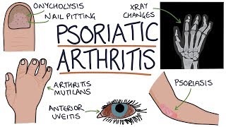 Psoriatic Arthritis [upl. by Zoller248]