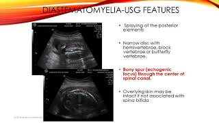 A case of diastematomyeliaSplit cord [upl. by Azar]