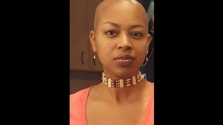 My Hair Journey with Scarring Alopecia [upl. by Renaxela]