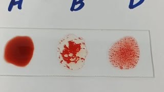 how to perform blood groupblood group ABO blood groupingB positive blood group [upl. by Ragde719]