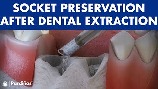 Tooth extraction  Treatment for socket preservation © [upl. by Markson]