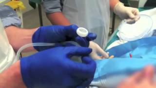 Peg Tube Insertion Video [upl. by Einahc730]