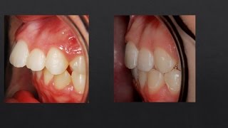 8mm Overjet Correction Orthodontics [upl. by Cardinal612]