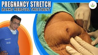 Pregnancy Stretch Marks Removal Treatment in Delhi  Care Well Medical Centre [upl. by Litt]