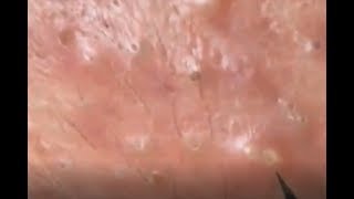 Milia𝑨cne Clear Th How to Removal Blackheads amp Whiteheads on Face at home Part48 [upl. by Neztnaj]