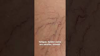 How to Tell if You Have Spider Veins [upl. by Eicats817]