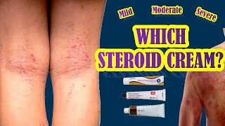 Which Steroid Cream Works Best For Eczema  Mild Moderate Severe Eczema Treatment [upl. by Alvin]