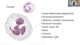 Neutrophilia  GAME 44  Pathology practical slides  MBBS  SRM  Dr GSS  University questions [upl. by Edas]