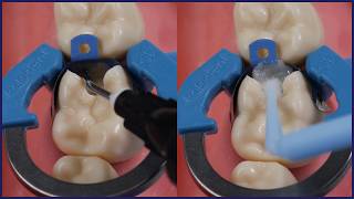 How To Marginal Ridge Heights in Class II Restorations  Tips From Dr Lincoln Harris [upl. by Gawlas]